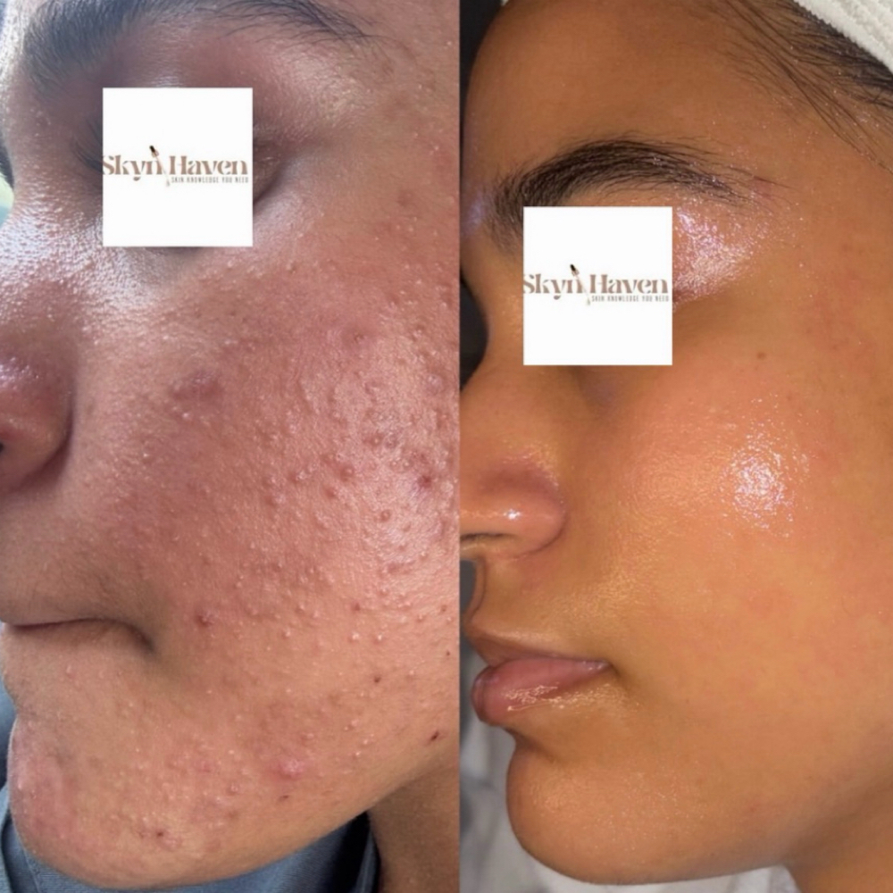 Clear Skyn Bootcamp Consult + First at Skyn Haven in Philadelphia, PA