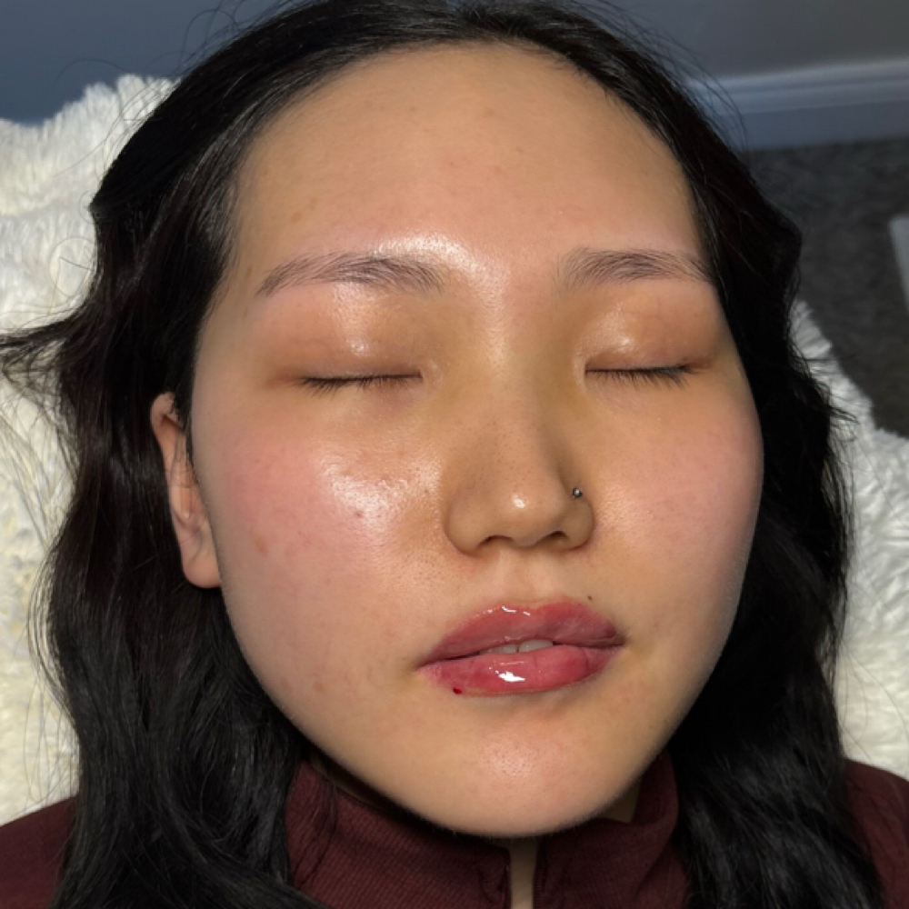 Restylane Kisse 1.2 at AIKO AESTHETICS in Melrose Park, IL