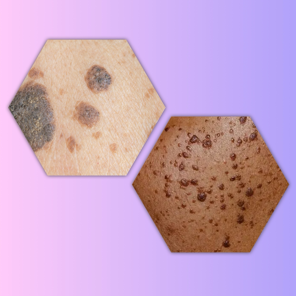 Dermatosis Papulosa Nigra (DPN)