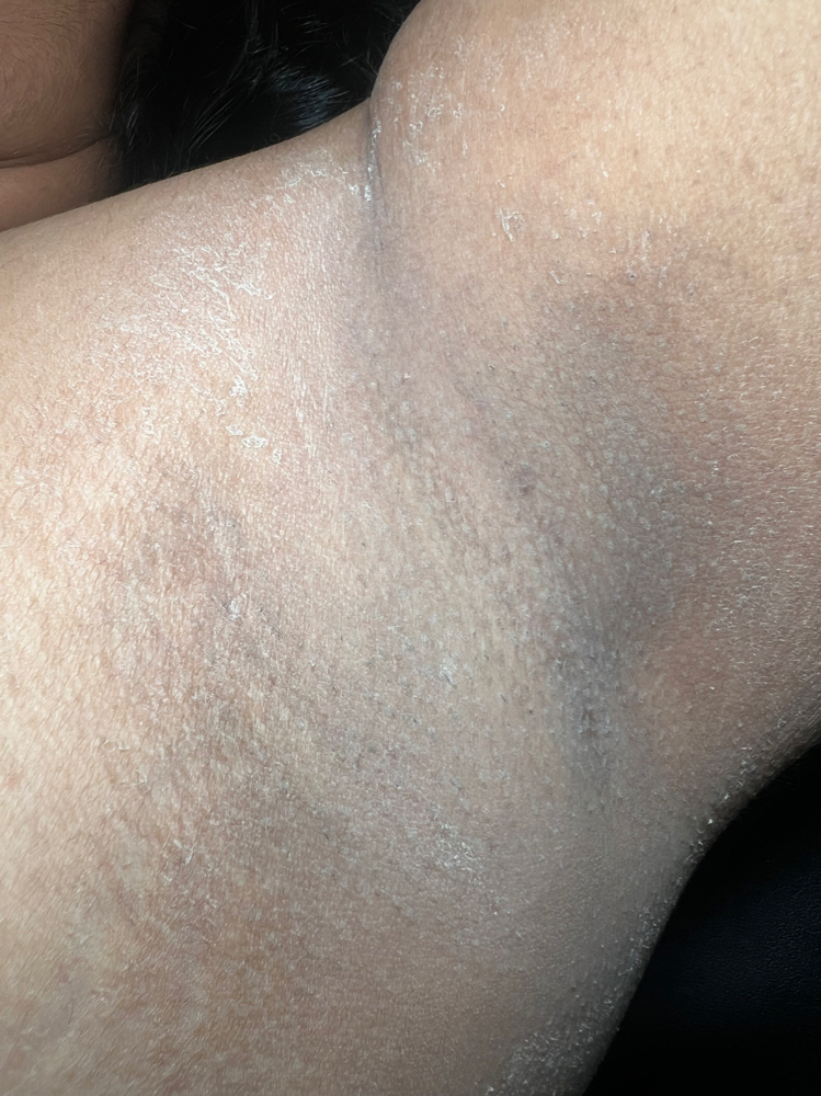 Underarms Lightening (1 Treatment)