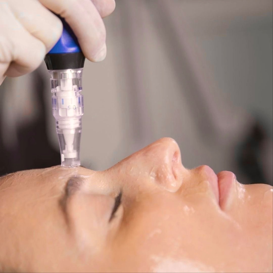 MICRONEEDLING + PEEL at LUMÉ skin in Alexandria, VA