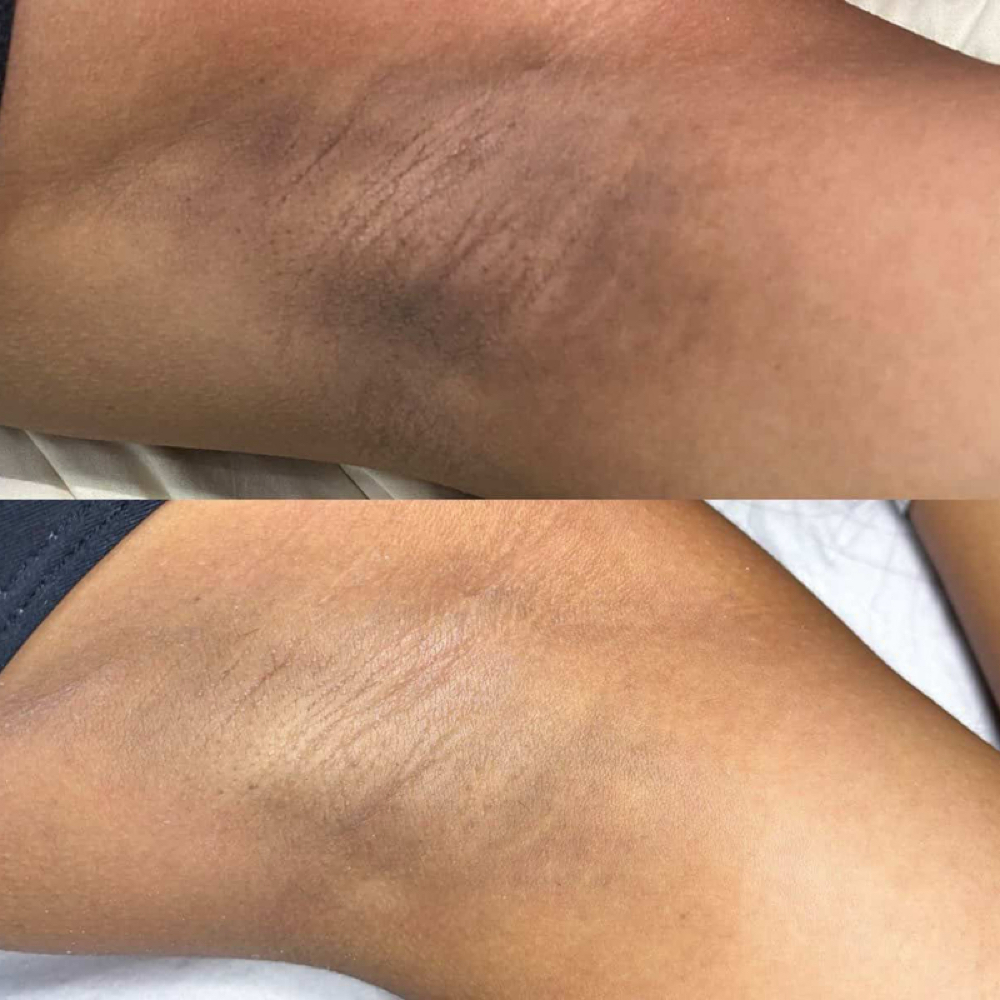 blanqueamiento de axilas (underarm at BY BAUTISSPA in Round Rock, TX