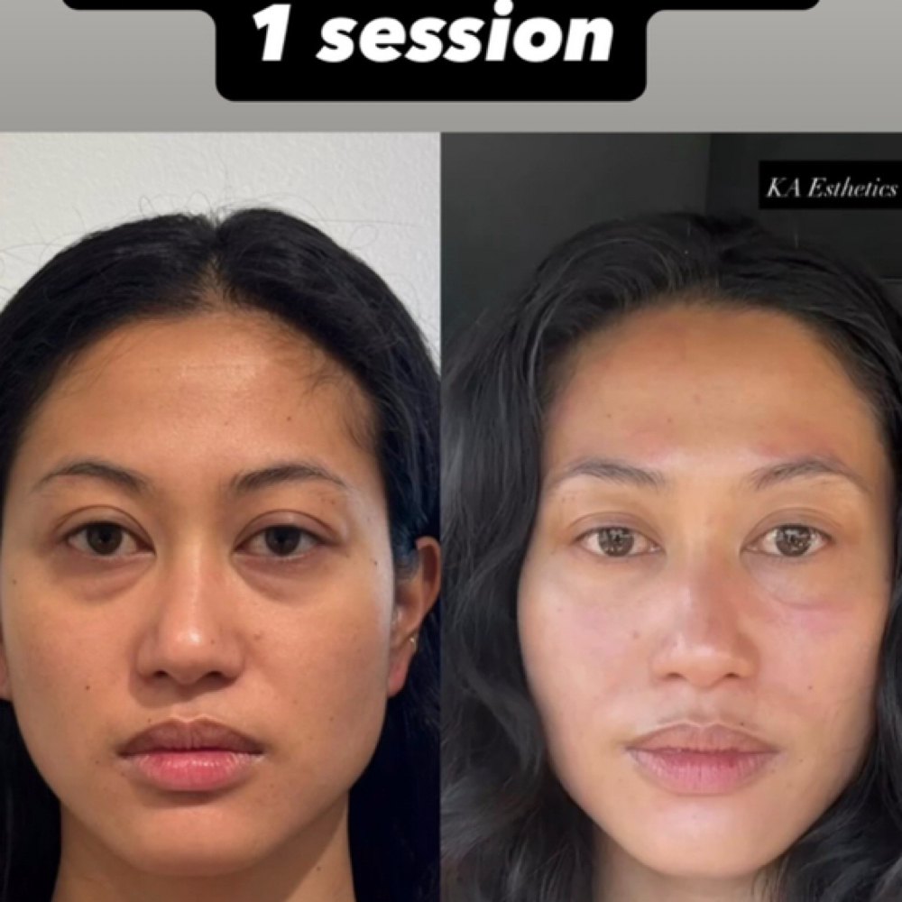 Buccal Treatments at Sachi Nails and Body Spa in Yonkers, NY