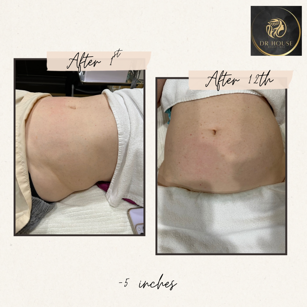 Stomach Sculpt & Tighten