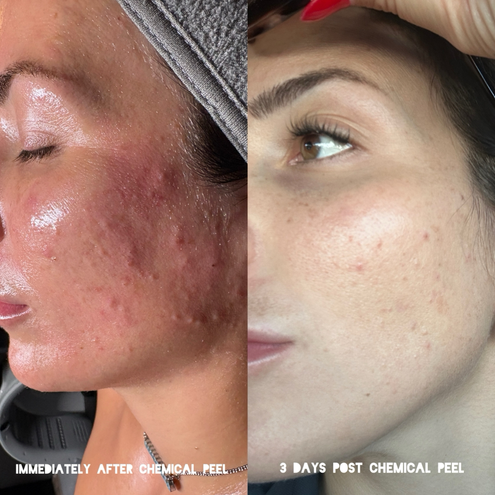 Custom Chemical Peel