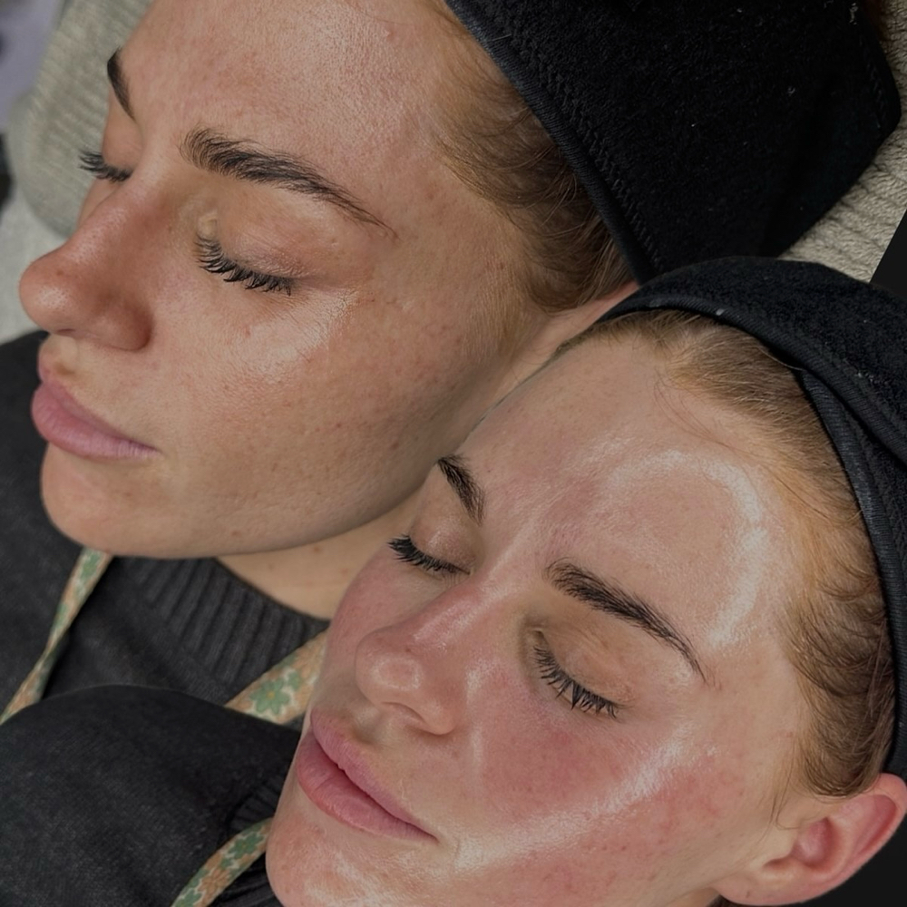 Custom Chemical Peel