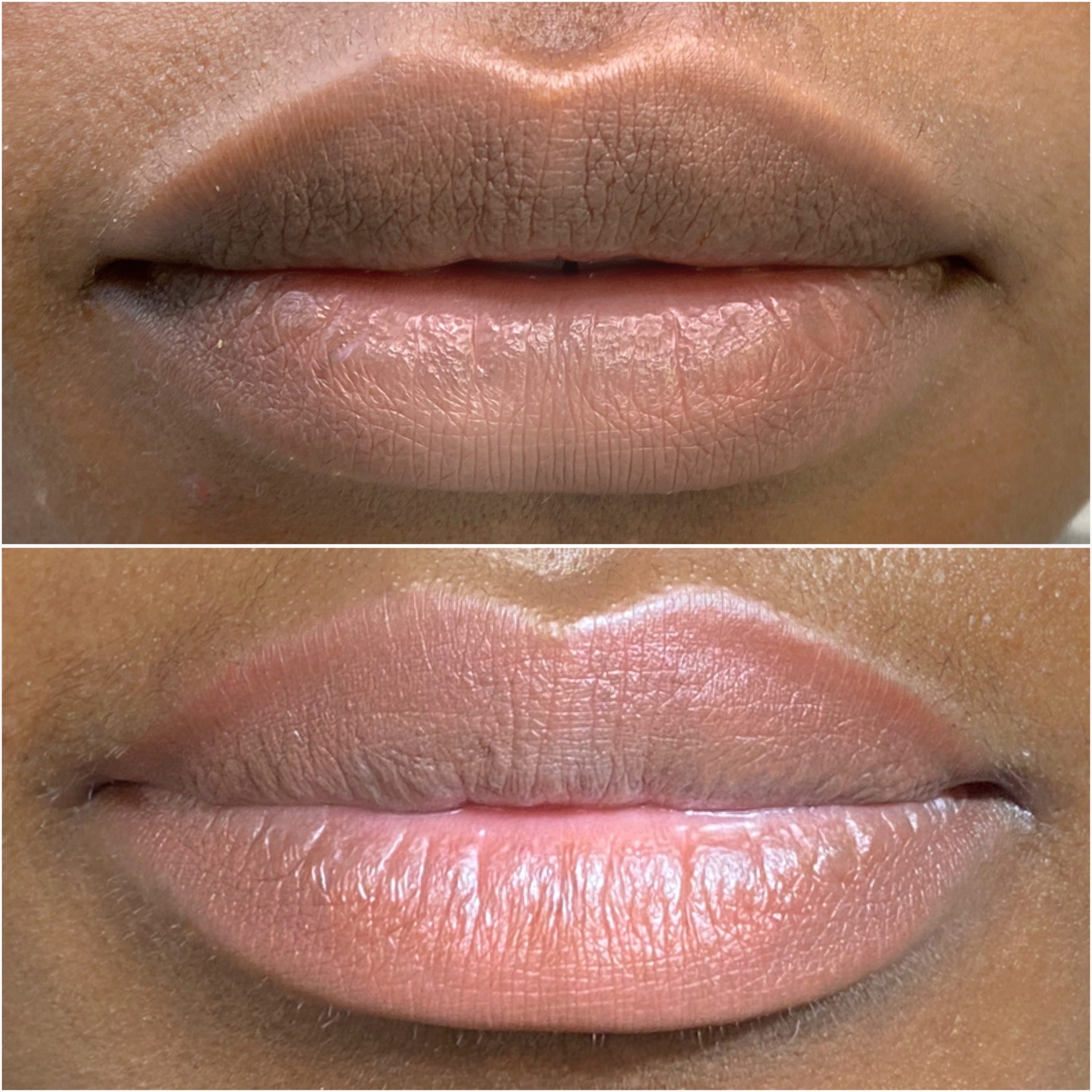 Lip Neutralization