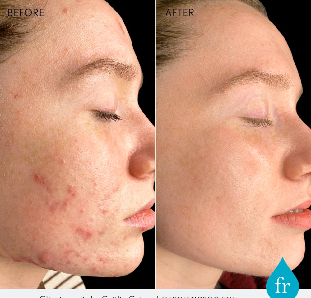 Existing Acne Bootcamp Clients Only