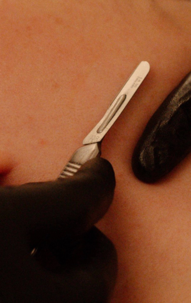 Dermaplane Add On