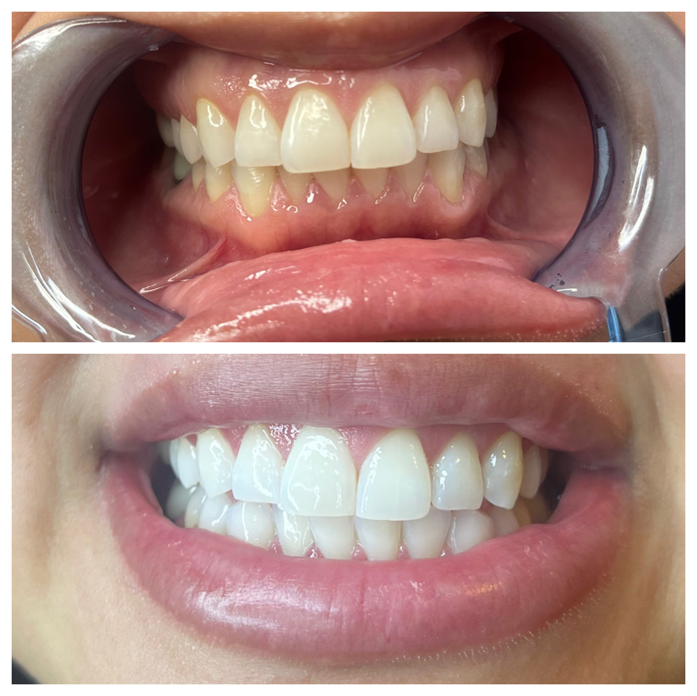 60 Min Teeth Whitening
