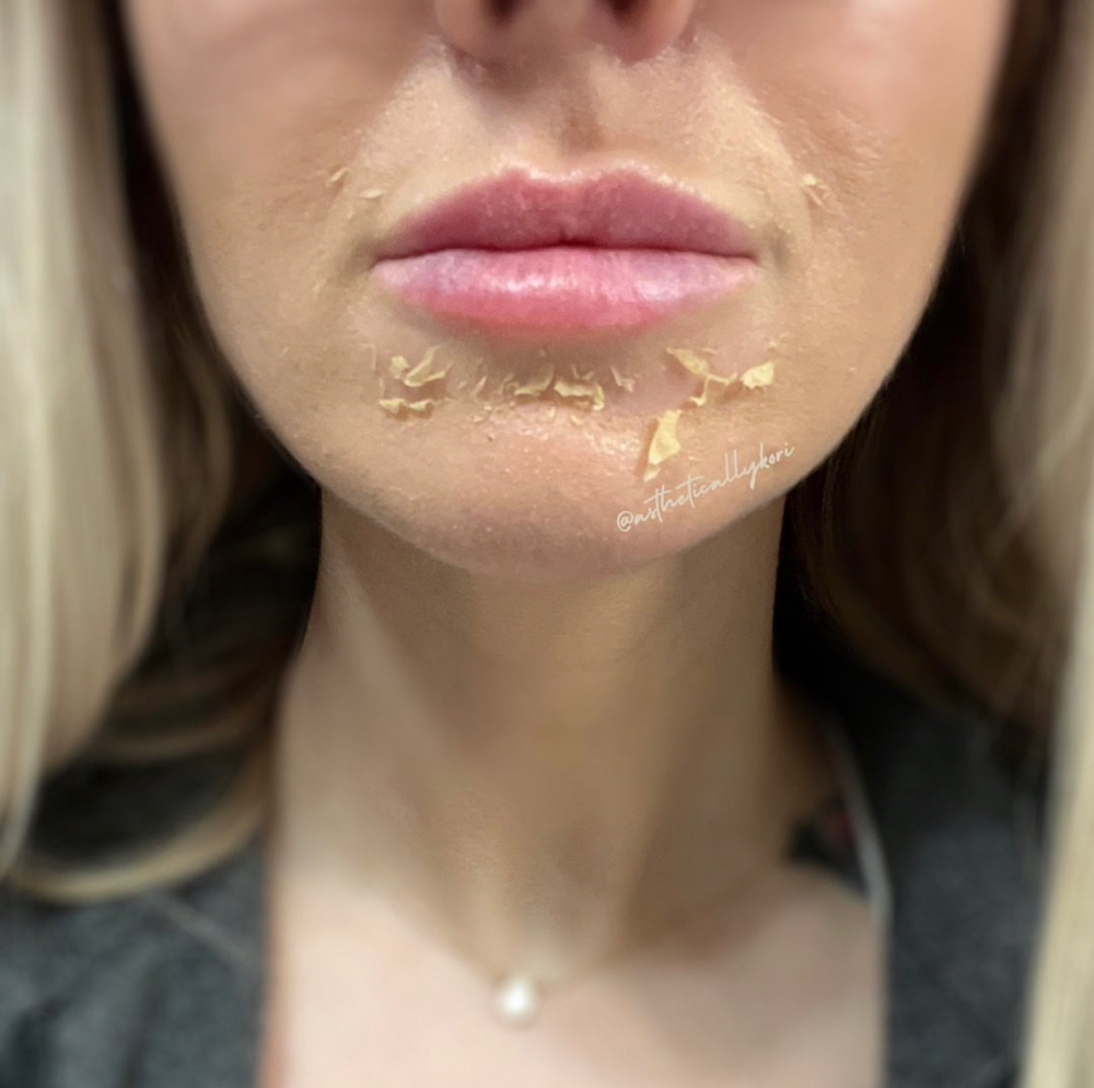 PCA Chemical Peel