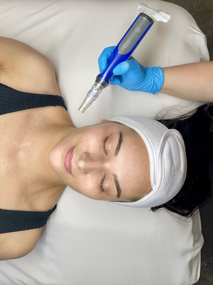 Microneedling