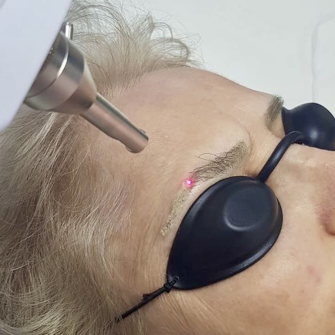 EYEBROW LASER PIGMENT REMOVAL