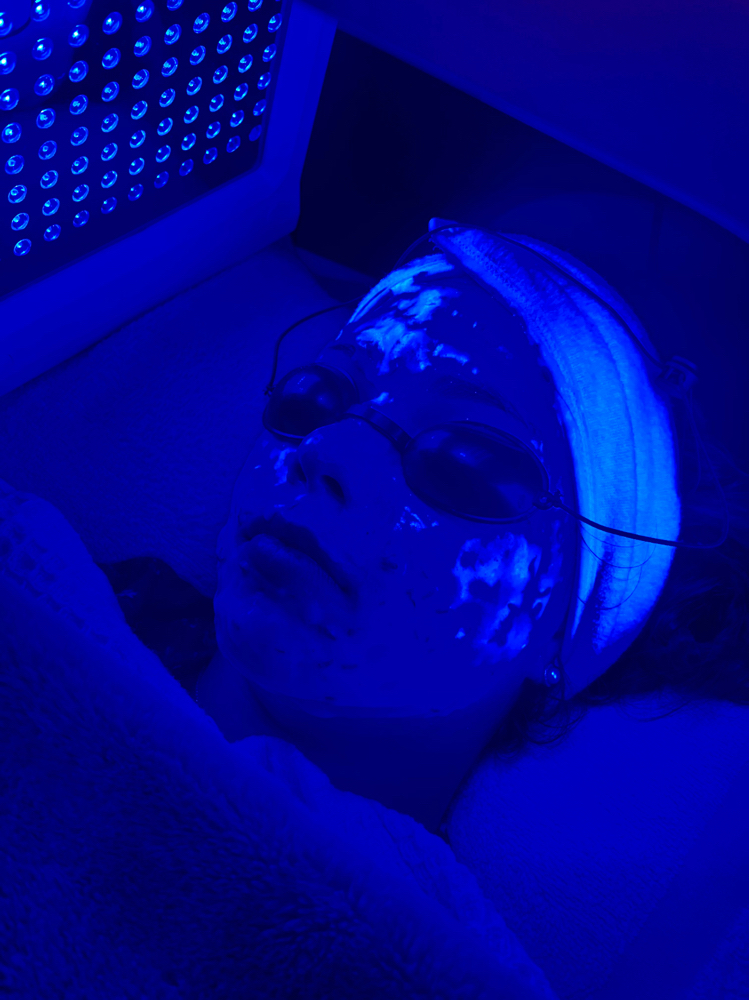 Acne Facial