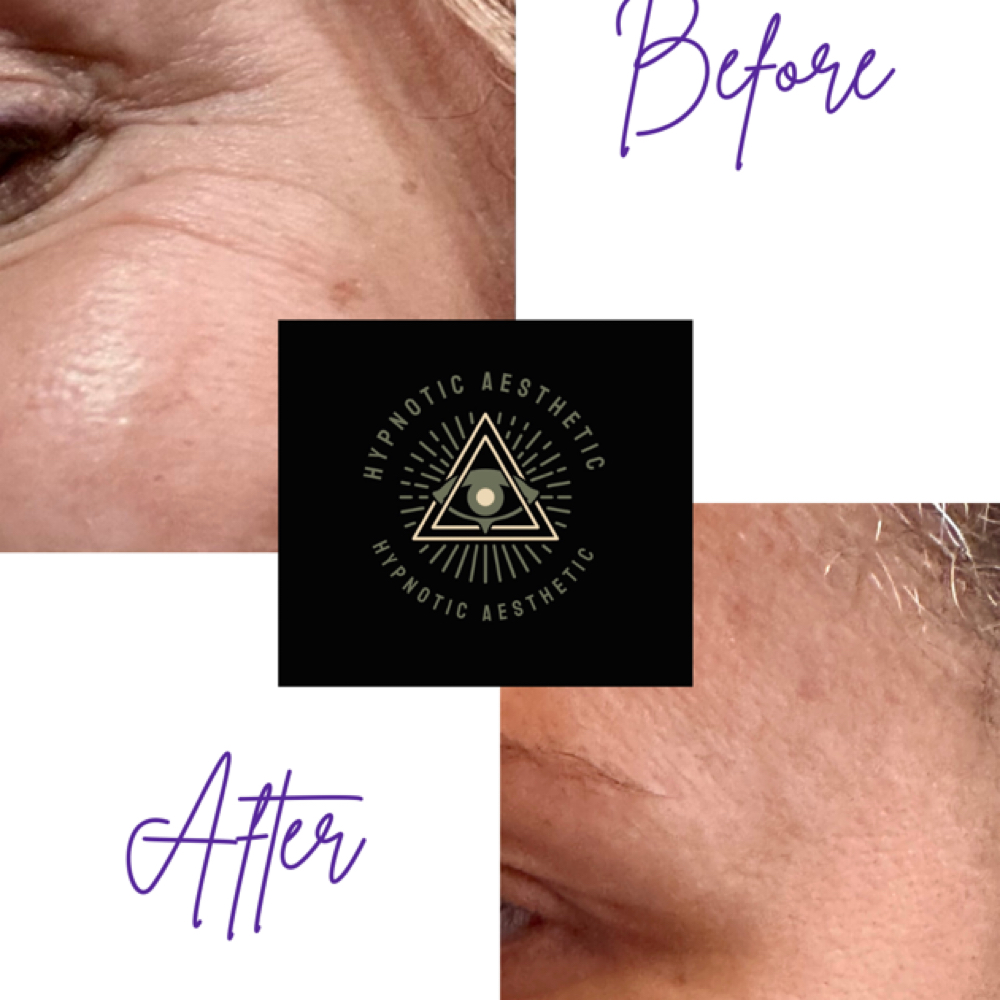 Crow’s Feet at Hypnotic Aesthetic in Lavon, TX