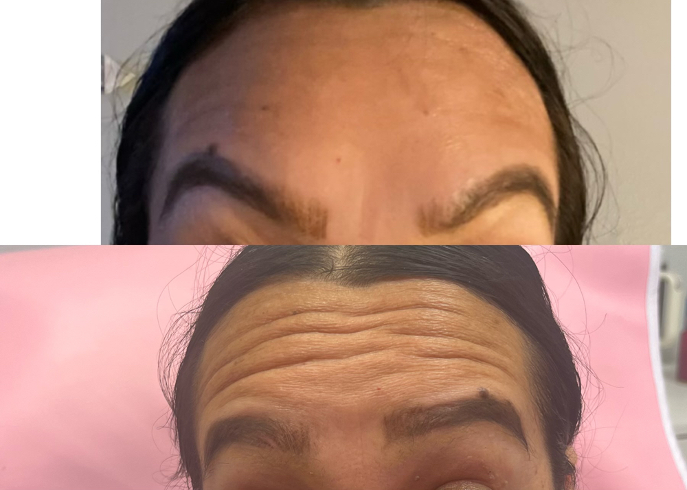 Forehead Botox