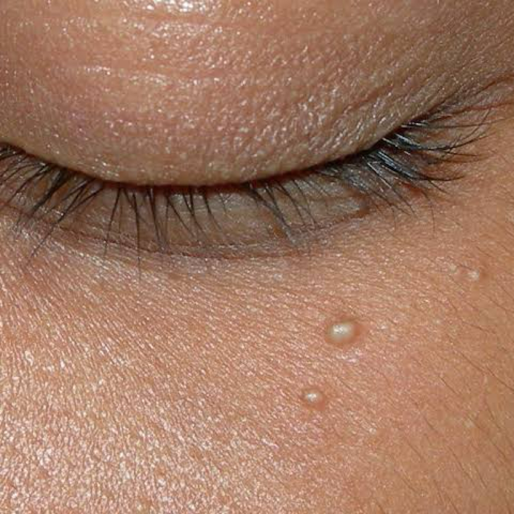 Milia Removal at Aimee Valdez in Litchfield Park, AZ