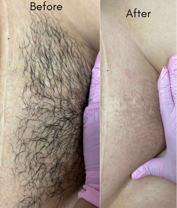 Brazilian wax