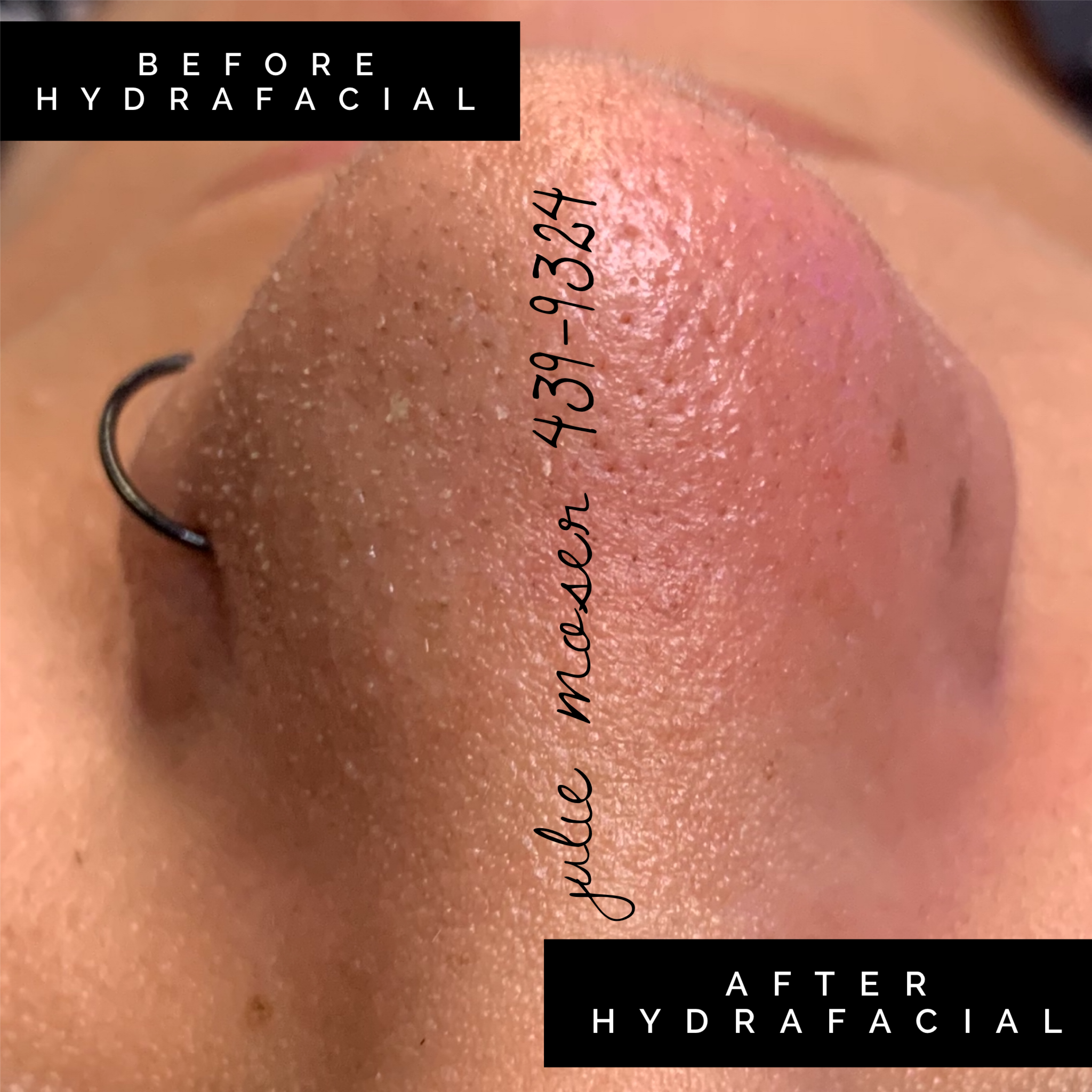 Platinum Hydrafacial Customized at Plush Spa in Joplin, MO