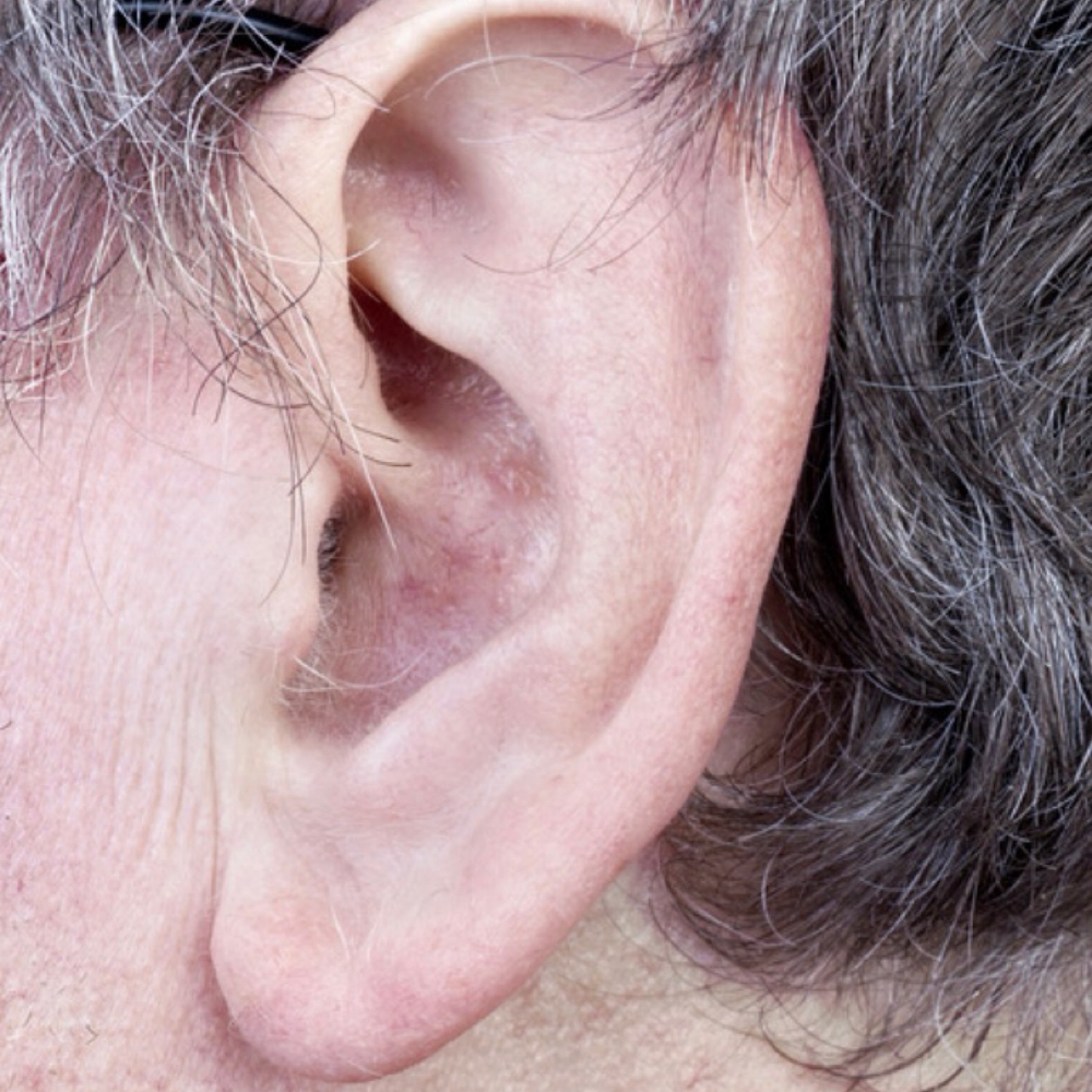 Ear IPL Hair Removal at Island Glow in Londonderry, NH