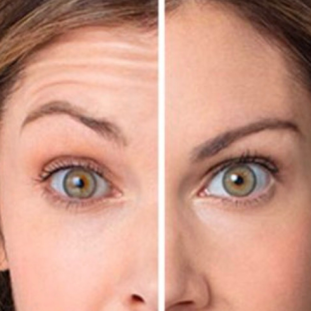 Forehead Injection at Precision Aesthetics LLC in Harrodsburg, KY
