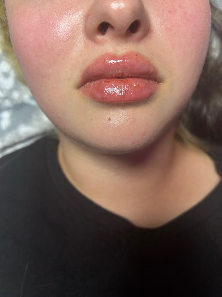 Needle FREE Lip filler