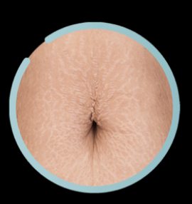 Plasma Fibroblast Abdomen