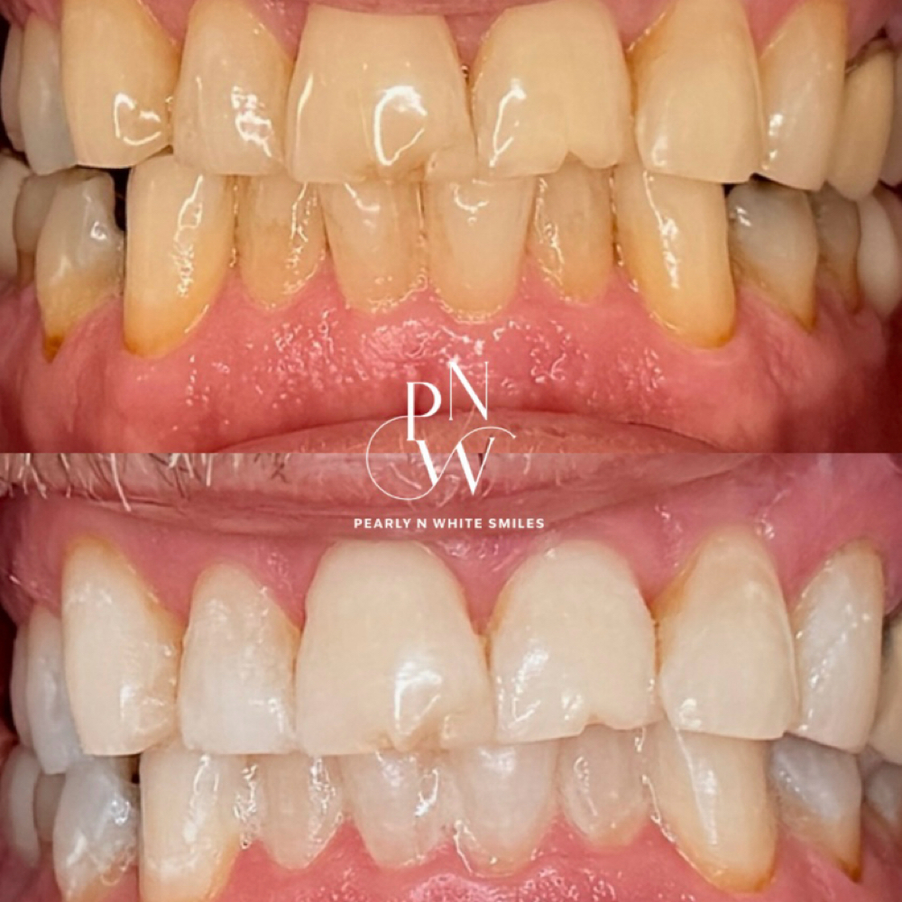 Fall Glow Special 🍂 at Pearly N White Smiles in Salem, OR