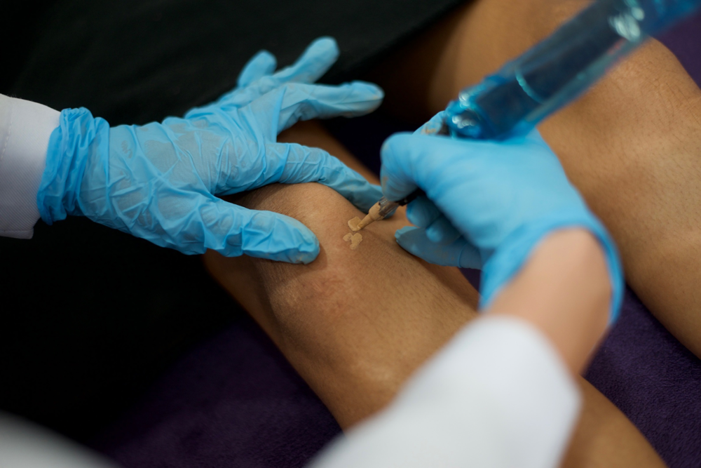 Inkless/Camo Stretchmarks Knee