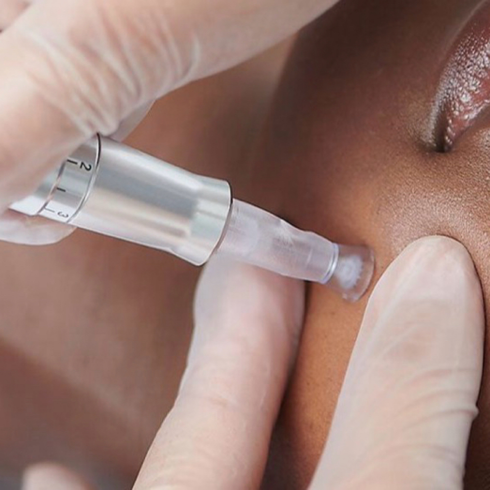 Nano-Needling Deluxe