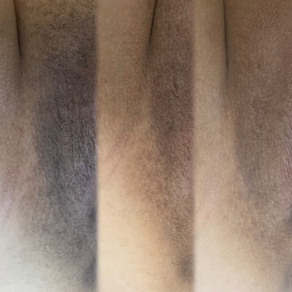 Intimate Brightening at Pura Belleza Aesthetics in Avondale, AZ