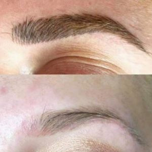 Eyebrow Removal 4-5 Treatments