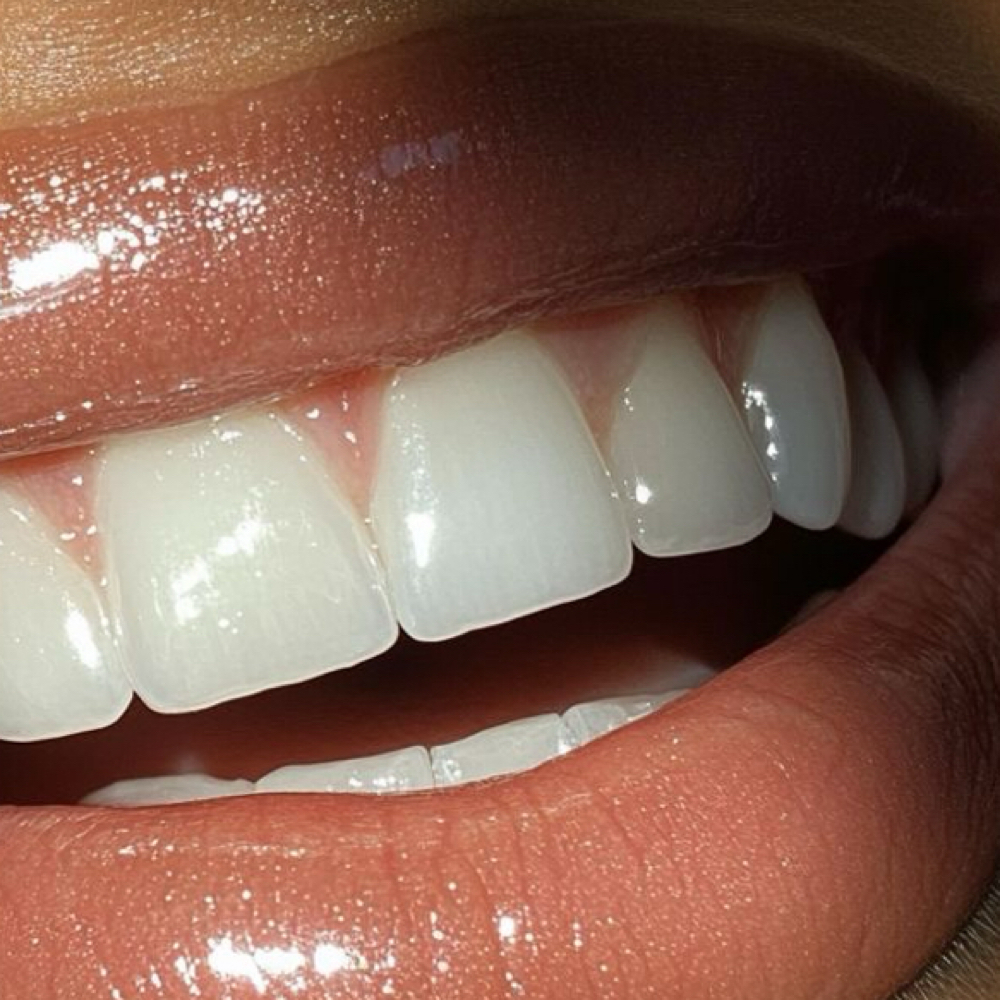High School Senior Teeth Whitening at Get Waxed By Aura in Salem, OR