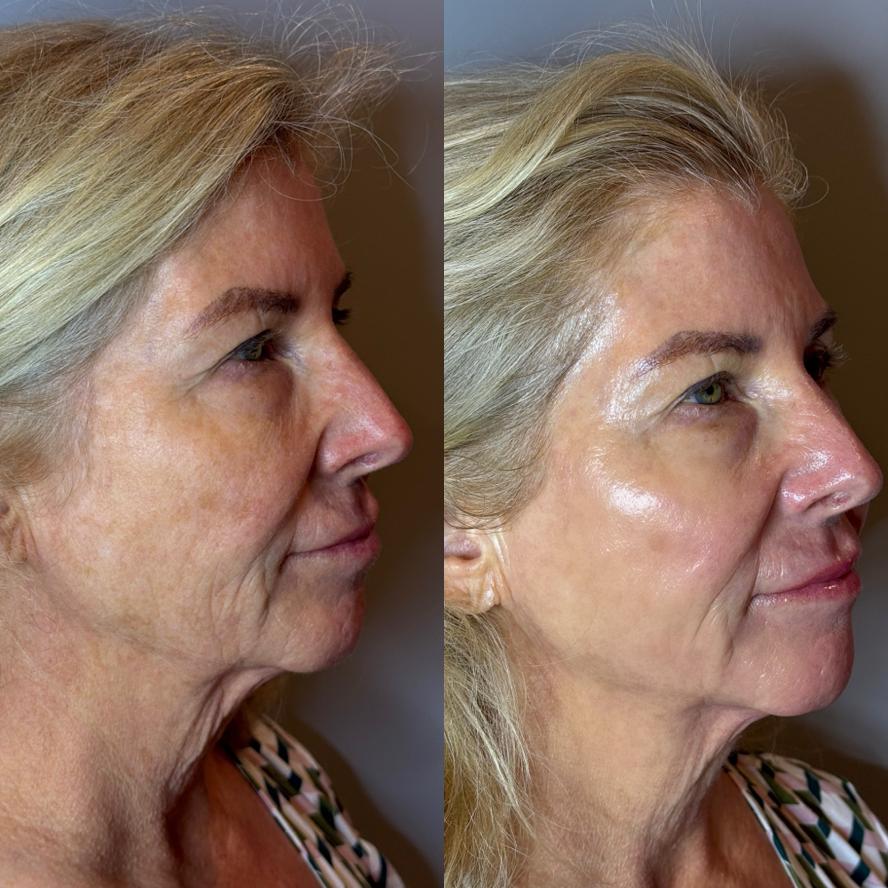 Instant Lift Facial