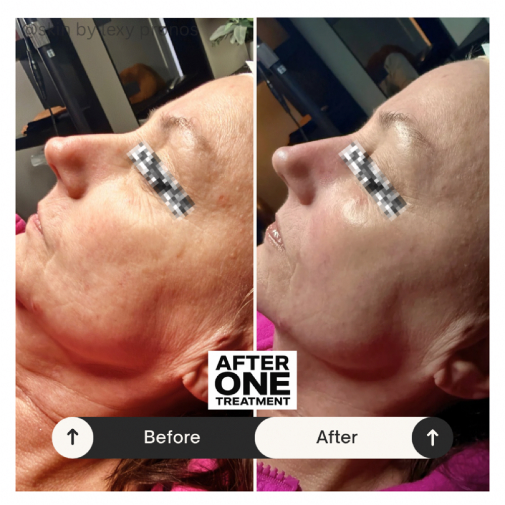 Corrective Aging Glow Facial at Gemini Esthetics in Naperville, IL