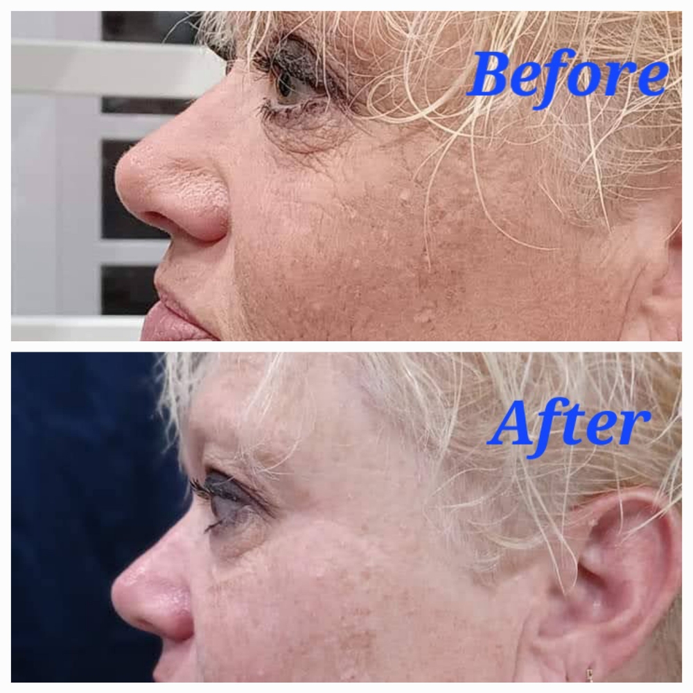 Skin Tightening  Face