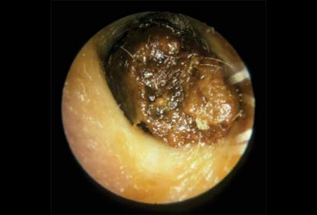 Deep impaction ear wax removal
