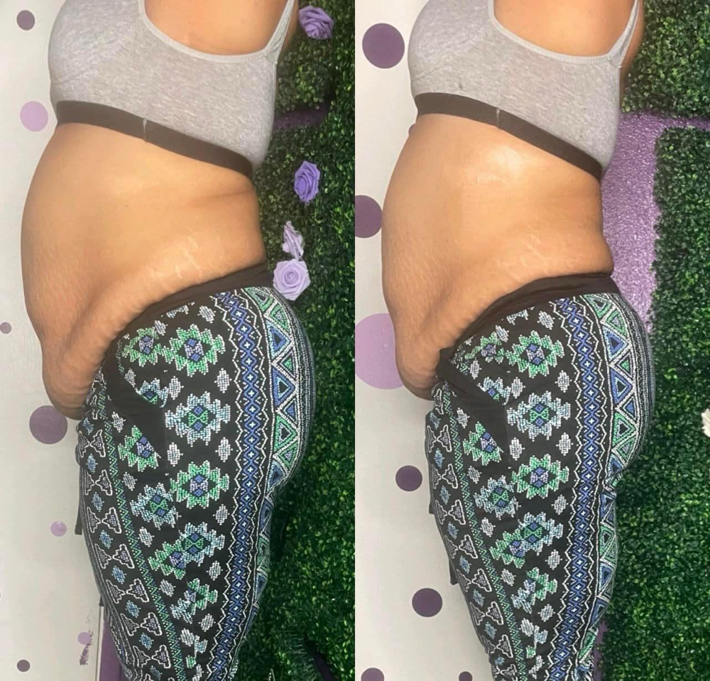 Non-surgical Lipo  60m