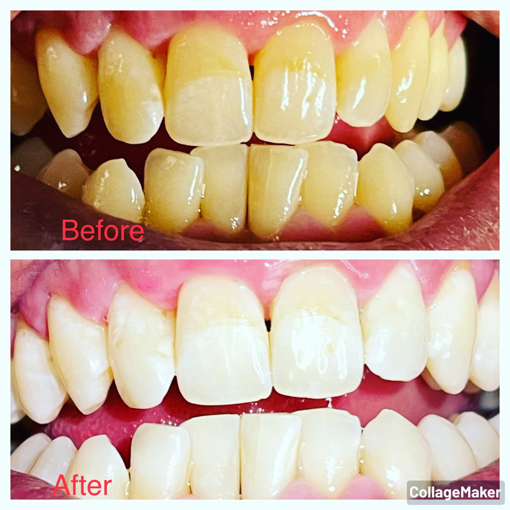 Teeth Whitening