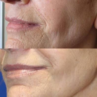Microneedling Series  of 6