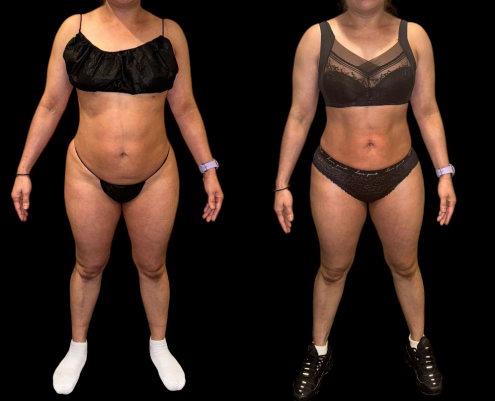Body Sculpting Evaluation at Haven Beauty Bar in Waltham, MA