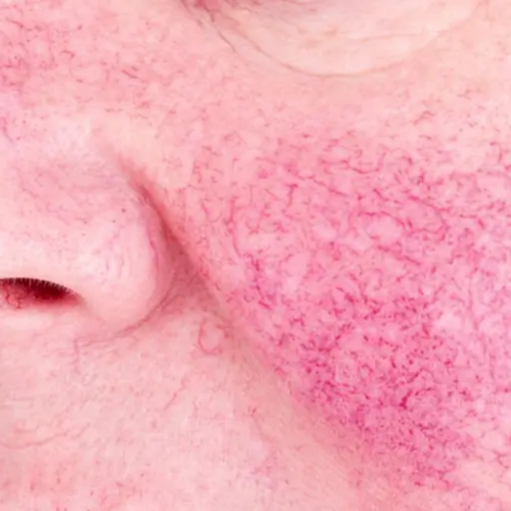 Facial Vascular Spot Treatment at PRYSM LIGHT in West Burlington, IA