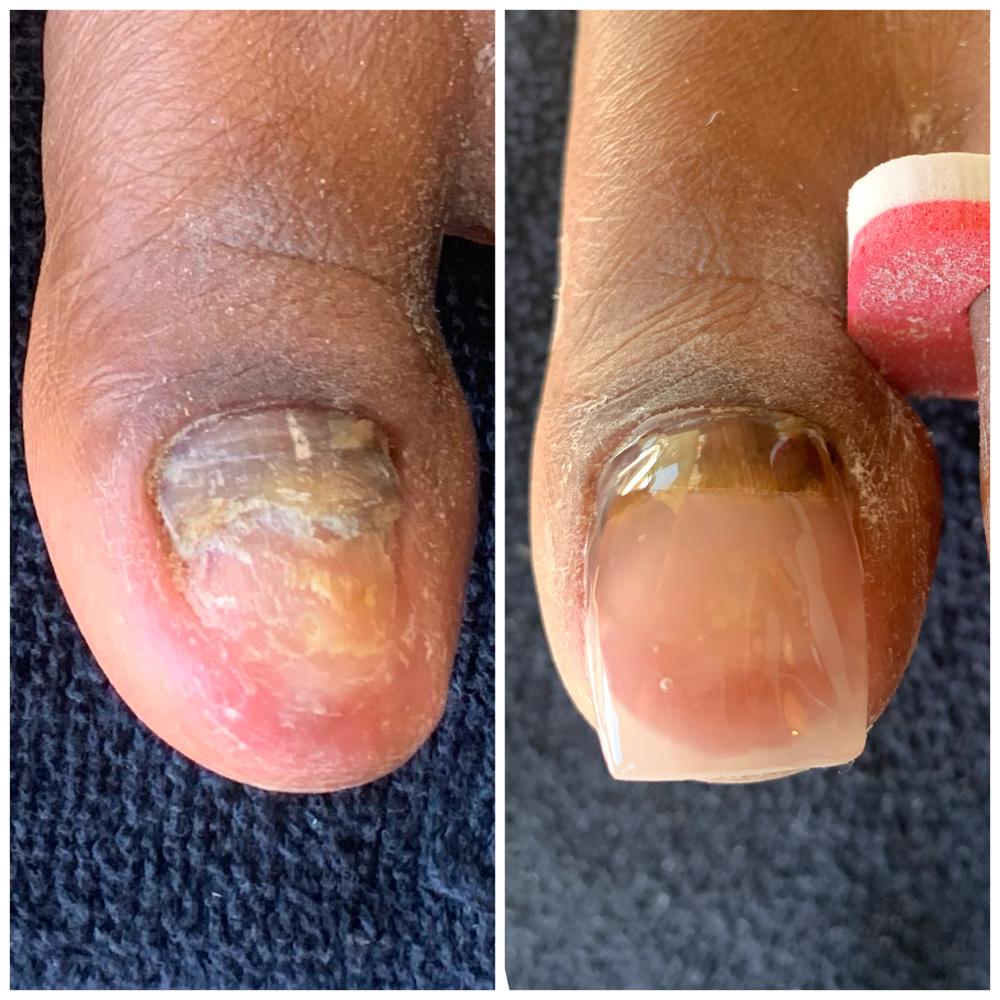 Toe Nail Reconstruction at Nail Ninja in Monrovia, CA