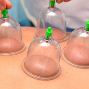 Cupping at RelaxRx Mobile Massage