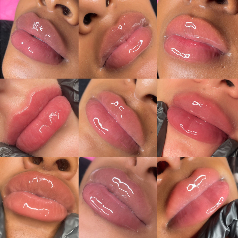 LIP FILLER BESTIE SPECIAL (1MLEACH)