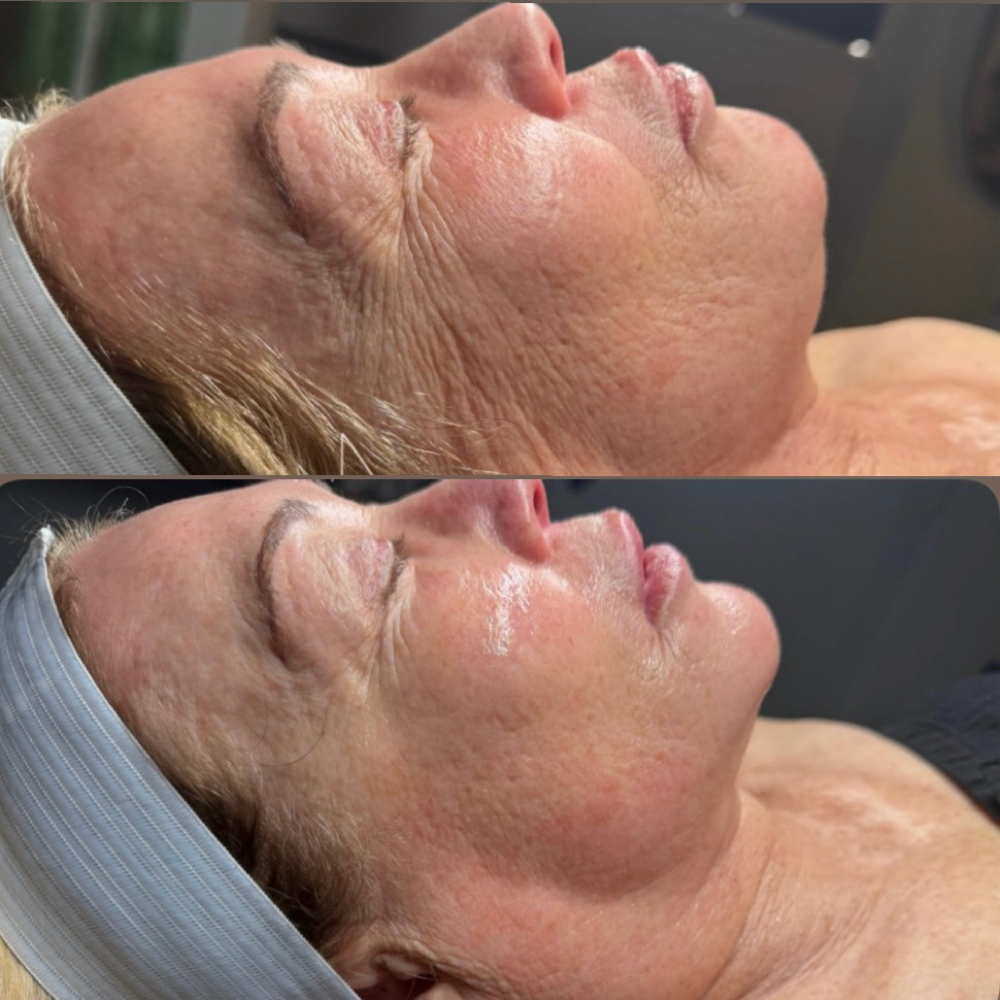 Microchanneling Face Neck&Décolleté at After Glow Esthetics in Galt, CA