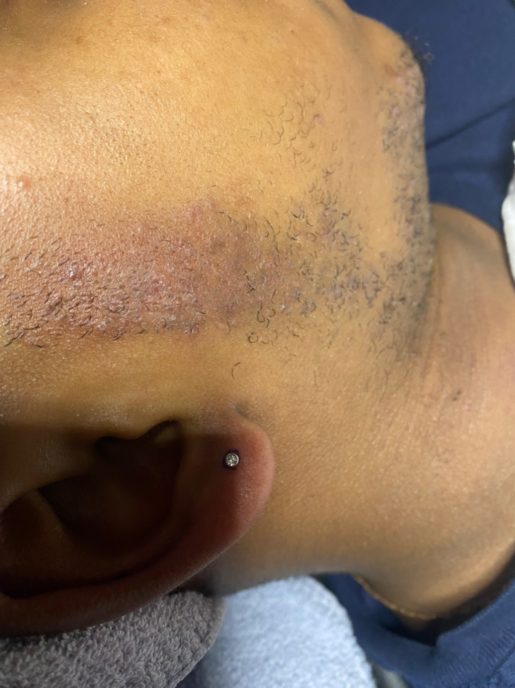 Treatment Facial