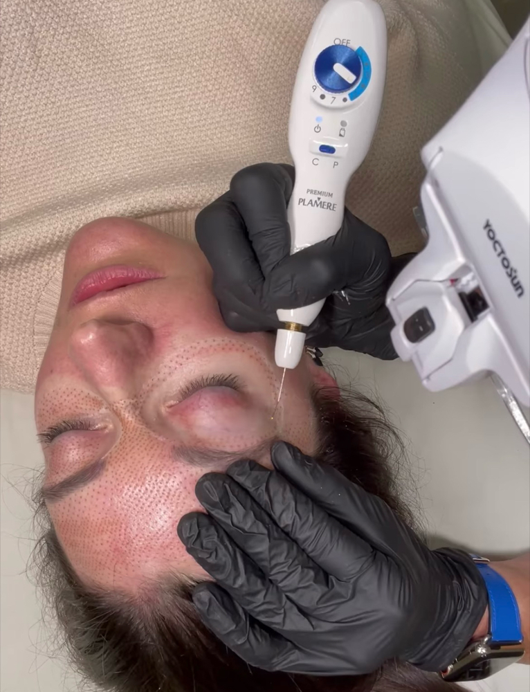 Fibroblast Plasma Skin Treatment