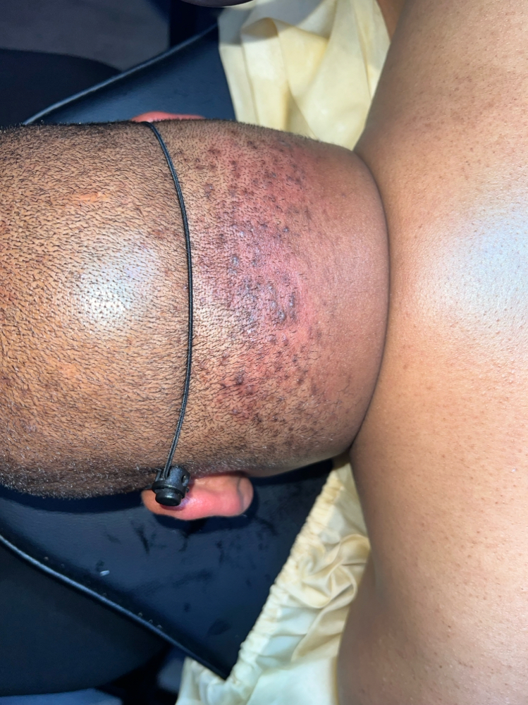 Ingrown Hair Removal