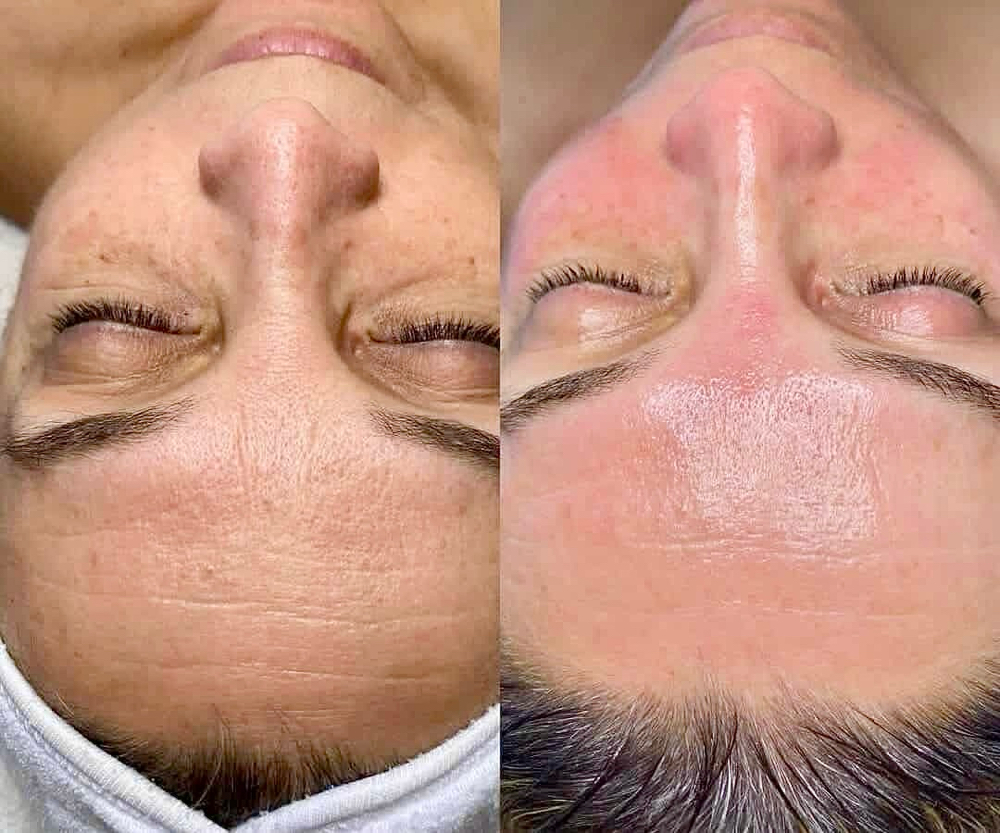 Ultherapy Glow Facial